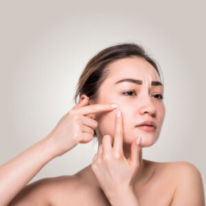 Read more about the article <strong>ACNE</strong>